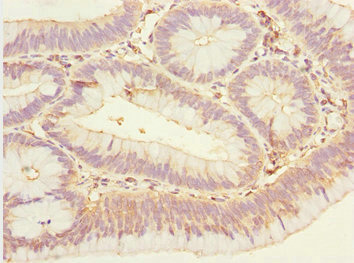 EYA3 Antibody - Immunohistochemistry of paraffin-embedded human colon cancer at dilution 1:100