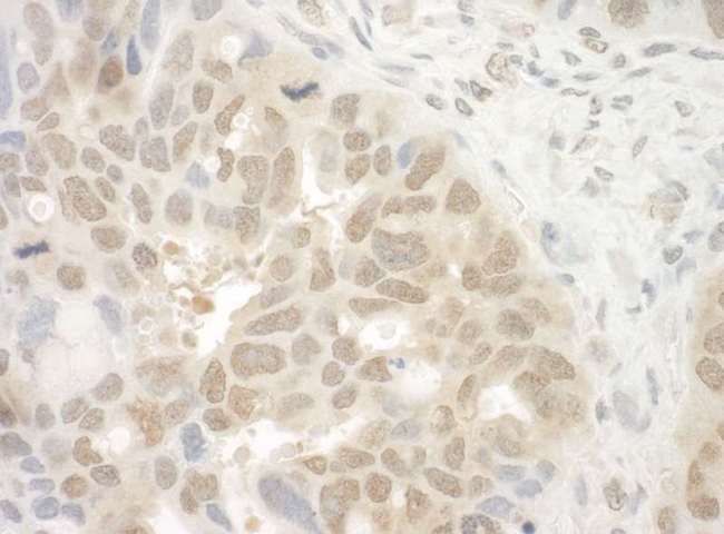 EYA4 Antibody - Detection of Human EYA4 by Immunohistochemistry. Sample: FFPE section of human ovarian carcinoma. Antibody: Affinity purified rabbit anti-EYA4 used at a dilution of 1:250.