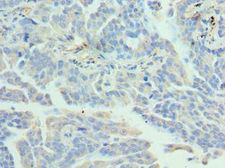 EZH1 / ENX-2 Antibody - Immunohistochemistry of paraffin-embedded human lung cancer using antibody at 1:100 dilution.