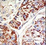 EZH1 / ENX-2 Antibody - Formalin-fixed and paraffin-embedded human cancer tissue reacted with the primary antibody, which was peroxidase-conjugated to the secondary antibody, followed by DAB staining. This data demonstrates the use of this antibody for immunohistochemistry; clinical relevance has not been evaluated. BC = breast carcinoma; HC = hepatocarcinoma.