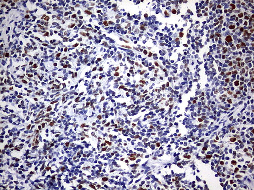 EZH2 Antibody - IHC of paraffin-embedded Human lymphoma tissue using anti-EZH2 mouse monoclonal antibody. (Heat-induced epitope retrieval by 1 mM EDTA in 10mM Tris, pH9.0, 120°C for 3min).