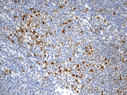 EZH2 Antibody - Immunohistochemical staining of paraffin-embedded Human lymphoma tissue using anti-EZH2 mouse monoclonal antibody. (Heat-induced epitope retrieval by 1mM EDTA in 10mM Tris buffer. (pH9.0) at 120°C for 2.5 min. (1:100)