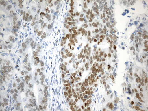 EZH2 Antibody - Immunohistochemical staining of paraffin-embedded Human Gastric Carcinoma using anti-EZH2 mouse monoclonal antibody. (Heat-induced epitope retrieval by 1mM EDTA in 10mM Tris buffer. (pH9.0) at 120°C for 2.5 min. (1:100)