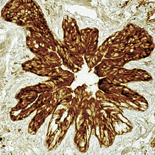 EZR / Ezrin Antibody - Formalin-fixed, paraffin-embedded human lung stained with Ezrin antibody.