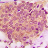 Ezrin + Radixin + Moesin Antibody - Immunohistochemical analysis of Ezrin/Radixin/Moesin staining in human breast cancer formalin fixed paraffin embedded tissue section. The section was pre-treated using heat mediated antigen retrieval with sodium citrate buffer (pH 6.0). The section was then incubated with the antibody at room temperature and detected using an HRP polymer system. DAB was used as the chromogen. The section was then counterstained with hematoxylin and mounted with DPX.