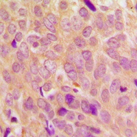 Ezrin + Radixin + Moesin Antibody - Immunohistochemical analysis of Ezrin/Radixin/Moesin (pT567/564/558) staining in human breast cancer formalin fixed paraffin embedded tissue section. The section was pre-treated using heat mediated antigen retrieval with sodium citrate buffer (pH 6.0). The section was then incubated with the antibody at room temperature and detected using an HRP conjugated compact polymer system. DAB was used as the chromogen. The section was then counterstained with hematoxylin and mounted with DPX.