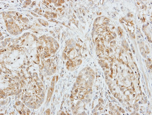 F10 / Factor X Antibody - IHC of paraffin-embedded A549 xenograft using Factor X antibody at 1:500 dilution.