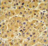 F10 / Factor X Antibody - F10 Antibody IHC of formalin-fixed and paraffin-embedded human hepatocarcinoma followed by peroxidase-conjugated secondary antibody and DAB staining.