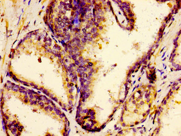 F12 / Factor XII Antibody - Immunohistochemistry image of paraffin-embedded human prostate cancer at a dilution of 1:100