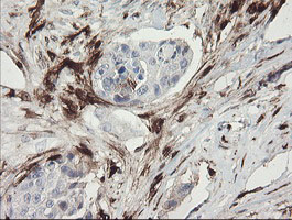F13A1 / Factor XIIIa Antibody - IHC of paraffin-embedded Adenocarcinoma of Human breast tissue using anti-F13A1 mouse monoclonal antibody.