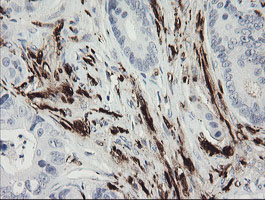 F13A1 / Factor XIIIa Antibody - IHC of paraffin-embedded Adenocarcinoma of Human colon tissue using anti-F13A1 mouse monoclonal antibody.
