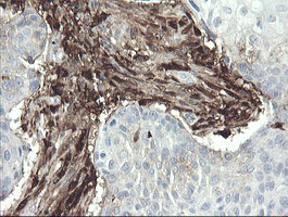 F13A1 / Factor XIIIa Antibody - IHC of paraffin-embedded Carcinoma of Human lung tissue using anti-F13A1 mouse monoclonal antibody.