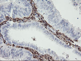F13A1 / Factor XIIIa Antibody - IHC of paraffin-embedded Adenocarcinoma of Human endometrium tissue using anti-F13A1 mouse monoclonal antibody.