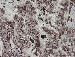 F13A1 / Factor XIIIa Antibody - IHC of paraffin-embedded Adenocarcinoma of Human ovary tissue using anti-F13A1 mouse monoclonal antibody.