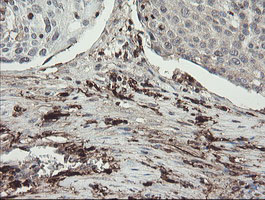 F13A1 / Factor XIIIa Antibody - IHC of paraffin-embedded Carcinoma of Human bladder tissue using anti-F13A1 mouse monoclonal antibody.