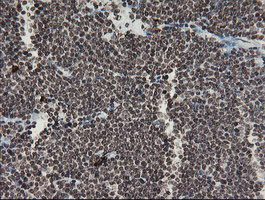 F13A1 / Factor XIIIa Antibody - IHC of paraffin-embedded Human lymphoma tissue using anti-F13A1 mouse monoclonal antibody.