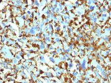 F13A1 / Factor XIIIa Antibody - IHC testing of FFPE human histiocytoma with Factor XIIIa antibody (clone F13A1/1448). Required HIER: boil tissue sections in 10mM citrate buffer, pH 6, for 10-20 min.