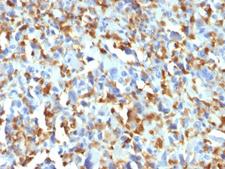 F13A1 / Factor XIIIa Antibody - IHC testing of FFPE human histiocytoma with Factor XIIIa antibody (clone F13A1/1683). Required HIER: boil tissue sections in 10mM citrate buffer, pH 6, for 10-20 min.