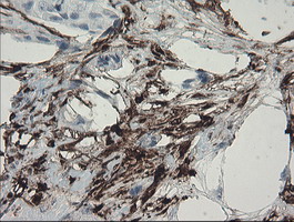 F13A1 / Factor XIIIa Antibody - IHC of paraffin-embedded Adenocarcinoma of Human breast tissue using anti-F13A1 mouse monoclonal antibody.