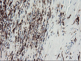 F13A1 / Factor XIIIa Antibody - IHC of paraffin-embedded Carcinoma of Human kidney tissue using anti-F13A1 mouse monoclonal antibody.