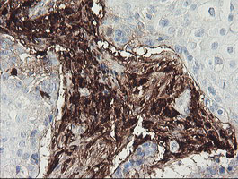 F13A1 / Factor XIIIa Antibody - IHC of paraffin-embedded Carcinoma of Human lung tissue using anti-F13A1 mouse monoclonal antibody.