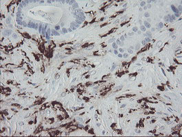 F13A1 / Factor XIIIa Antibody - IHC of paraffin-embedded Adenocarcinoma of Human colon tissue using anti-F13A1 mouse monoclonal antibody.