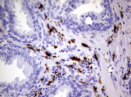 F13A1 / Factor XIIIa Antibody - IHC of paraffin-embedded Human prostate tissue using anti-F13A1 mouse monoclonal antibody. (Heat-induced epitope retrieval by 10mM citric buffer, pH6.0, 120°C for 3min).
