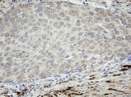 F13A1 / Factor XIIIa Antibody - IHC of paraffin-embedded Carcinoma of Human bladder tissue using anti-F13A1 mouse monoclonal antibody.