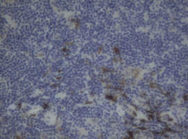 F13A1 / Factor XIIIa Antibody - IHC of paraffin-embedded Human lymphoma tissue using anti-F13A1 mouse monoclonal antibody.