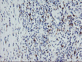 F13A1 / Factor XIIIa Antibody - IHC of paraffin-embedded Carcinoma of Human kidney tissue using anti-F13A1 mouse monoclonal antibody.