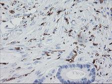 F13A1 / Factor XIIIa Antibody - IHC of paraffin-embedded Adenocarcinoma of Human colon tissue using anti-F13A1 mouse monoclonal antibody.