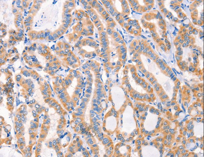 F13A1 / Factor XIIIa Antibody - Immunohistochemistry of paraffin-embedded Human lung cancer using F13A1 Polyclonal Antibody at dilution of 1:80.