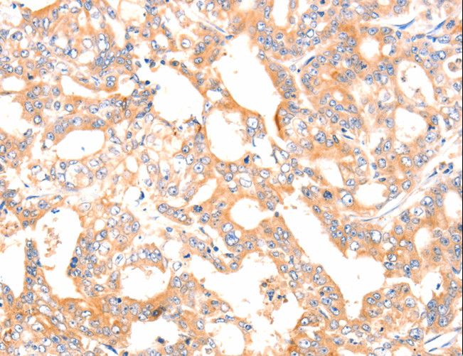 F13A1 / Factor XIIIa Antibody - Immunohistochemistry of paraffin-embedded Human gastric cancer using F13A1 Polyclonal Antibody at dilution of 1:80.