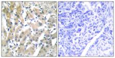 F2 / Prothrombin / Thrombin Antibody - Immunohistochemistry analysis of paraffin-embedded human liver carcinoma tissue, using THRB Antibody. The picture on the right is blocked with the synthesized peptide.
