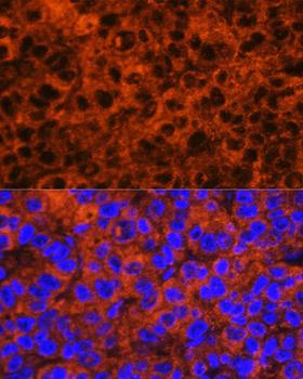 F2 / Prothrombin / Thrombin Antibody - Immunofluorescence analysis of human liver cancer using F2 antibody at dilution of 1:100. Blue: DAPI for nuclear staining.
