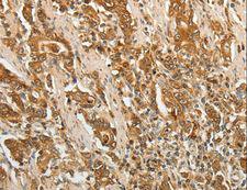 F3 / CD142 / Tissue factor Antibody - Immunohistochemistry of paraffin-embedded Human gastric cancer using F3 Polyclonal Antibody at dilution of 1:25.
