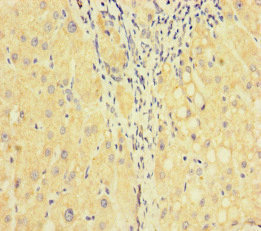 F5 / Factor Va Antibody - Immunohistochemistry of paraffin-embedded human liver cancer at dilution of 1:100