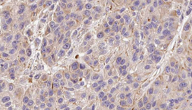 F5 / Factor Va Antibody - 1:100 staining human Melanoma tissue by IHC-P. The sample was formaldehyde fixed and a heat mediated antigen retrieval step in citrate buffer was performed. The sample was then blocked and incubated with the antibody for 1.5 hours at 22°C. An HRP conjugated goat anti-rabbit antibody was used as the secondary.