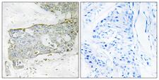 F7 / Factor VII Antibody - Cl-peptide - + Immunohistochemistry analysis of paraffin-embedded human breast carcinoma tissue using FA7 (light chain, Cleaved-Arg212) antibody.