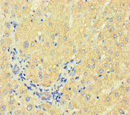 F7 / Factor VII Antibody - Immunohistochemistry of paraffin-embedded human liver cancer using F7 Antibody at dilution of 1:100