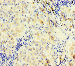 F7 / Factor VII Antibody - Immunohistochemistry of paraffin-embedded human lung cancer using F7 Antibody at dilution of 1:100