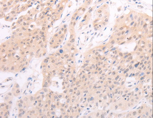 F7 / Factor VII Antibody - Immunohistochemistry of paraffin-embedded Human lung cancer using F7 Polyclonal Antibody at dilution of 1:40.