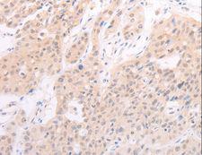 F7 / Factor VII Antibody - Immunohistochemistry of paraffin-embedded Human lung cancer using F7 Polyclonal Antibody at dilution of 1:40.
