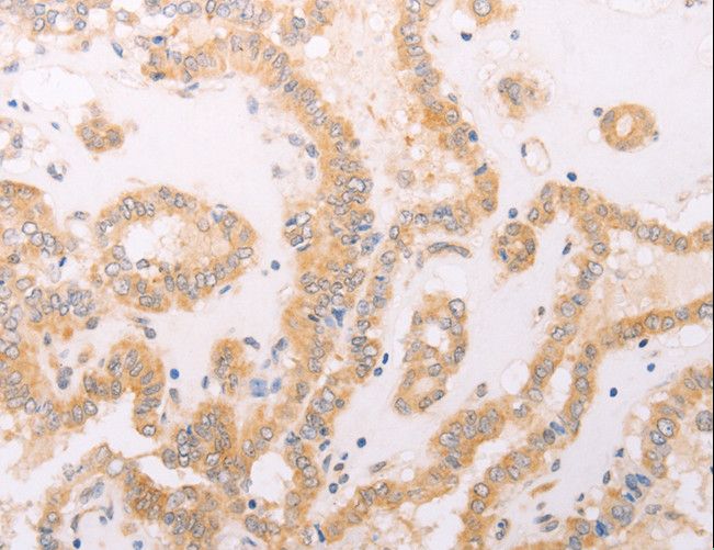 F7 / Factor VII Antibody - Immunohistochemistry of paraffin-embedded Human thyroid cancer using F7 Polyclonal Antibody at dilution of 1:40.