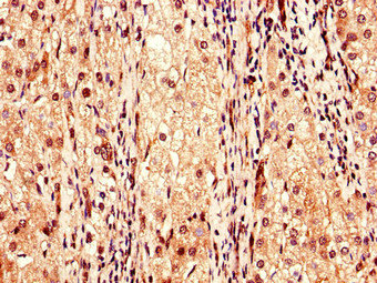 F9 / Factor IX Antibody - Immunohistochemistry of paraffin-embedded human liver cancer using F9 Antibody at dilution of 1:100