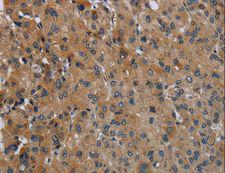 FAAH Antibody - Immunohistochemistry of paraffin-embedded Human liver cancer using FAAH Polyclonal Antibody at dilution of 1:50.