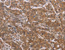 FAAH2 Antibody - Immunohistochemistry of paraffin-embedded Human colon cancer using FAAH2 Polyclonal Antibody at dilution of 1:30.