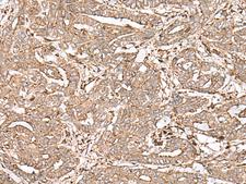FAAP24 Antibody - Immunohistochemistry of paraffin-embedded Human liver cancer tissue  using FAAP24 Polyclonal Antibody at dilution of 1:30(×200)