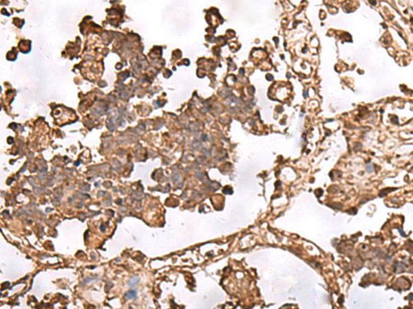 FAAP24 Antibody - Immunohistochemistry of paraffin-embedded Human lung cancer tissue  using FAAP24 Polyclonal Antibody at dilution of 1:30(×200)
