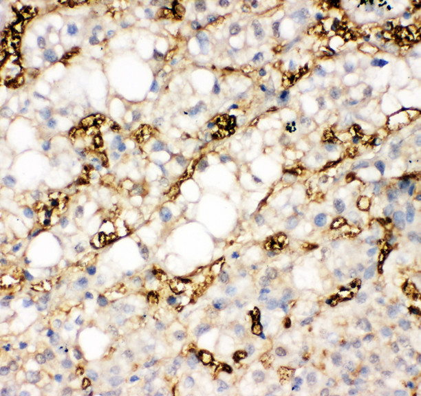 FABP1 / L-FABP Antibody - FABP1 / L-FABP antibody. IHC(P): Human Liver Cancer Tissue.